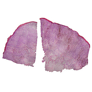 Prepared Microscope Slide,Melanoma, Human